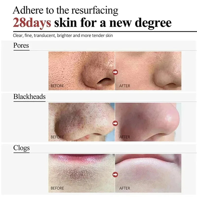 Sérum Pores & Acné